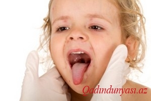 Uşaqlarda angina zamanı,yüksək hərarət zamanı boğazı silmək olarmı?