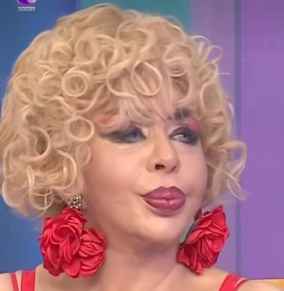 71 yaşlı sənətçi üzgərmə əməliyyatından sonra - FOTO