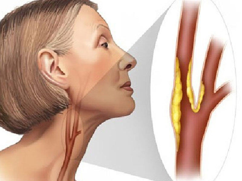 Атеросклероз сосудов брахиоцефальных артерий. Эндартерэктомия атеросклероз. Стеноз бифуркации сонной артерии. Атеросклероз сосудов брахиоцефальных артерий. Брахиоцефальные сосуды атеросклероз.