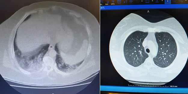 Mütəxəssis görüntülərini paylaşdı: koronavirus ciyərləri bu hala salır