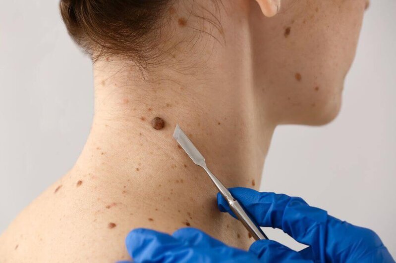 Dəridəki xallar nə vaxt təhlükəlidir? - Onkoloqdan açıqlama