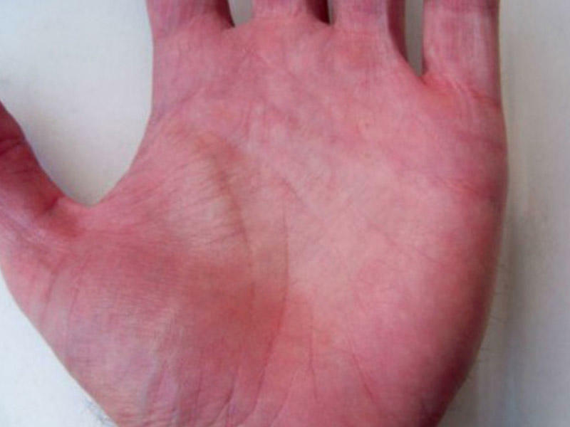 Əllərinizin içi qırmızıdırsa... Sizdə bu xəstəliklər ola bilər