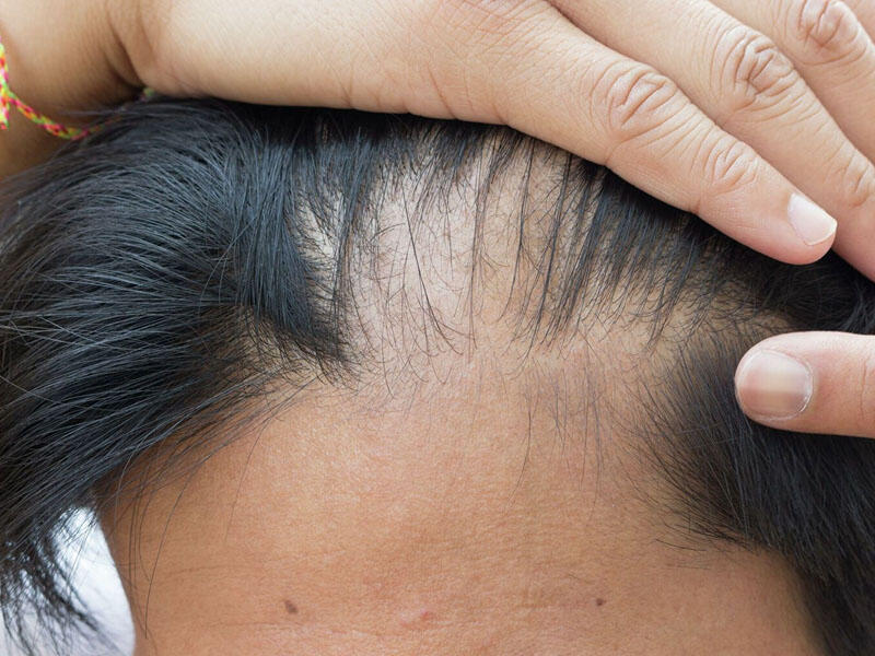 Koronavirusdan sonra karlıq və saç tökülməsi çoxalır