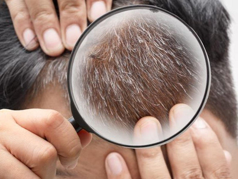 Erkən saç ağarmasının səbəbləri