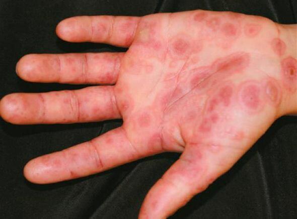 Ovucdakı əlamətlə qaraciyərdəki problemi müəyyənləşdirməyin yolları açıqlanıb - FOTO