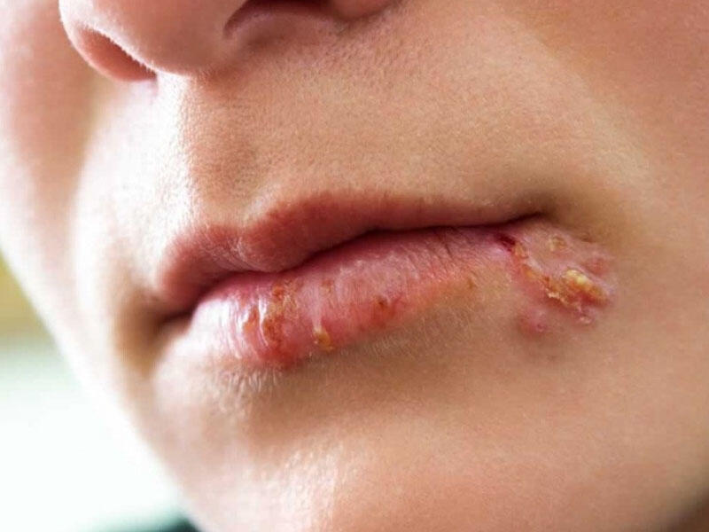 Herpes virusu və onunla mübarizə yolları