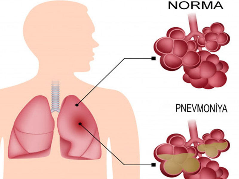 Pnevmoniyanın ən erkən 3 SİMPTOMU