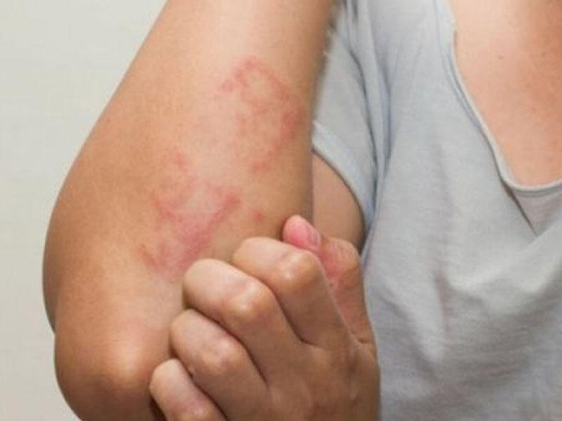 COVID-19-dan sonra yaranan allergik reaksiyalar