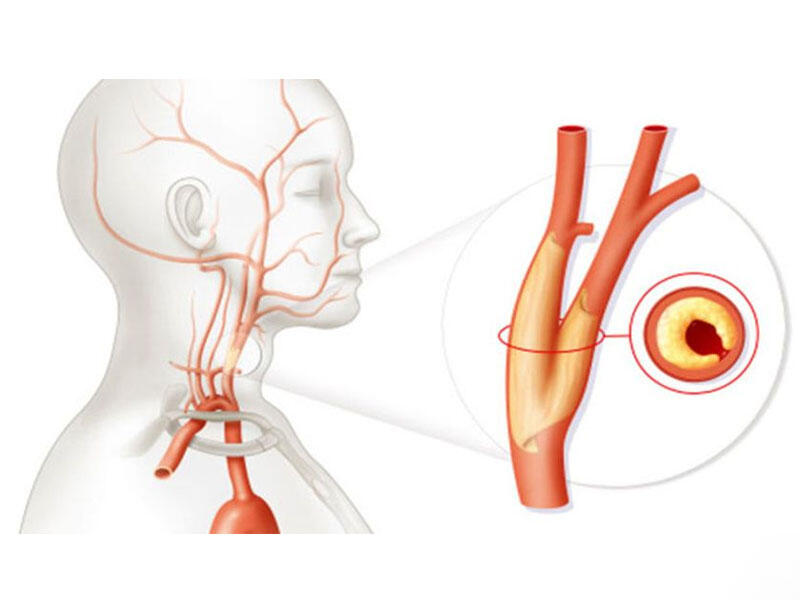 Şah damar tıxanıqlığı nədir?