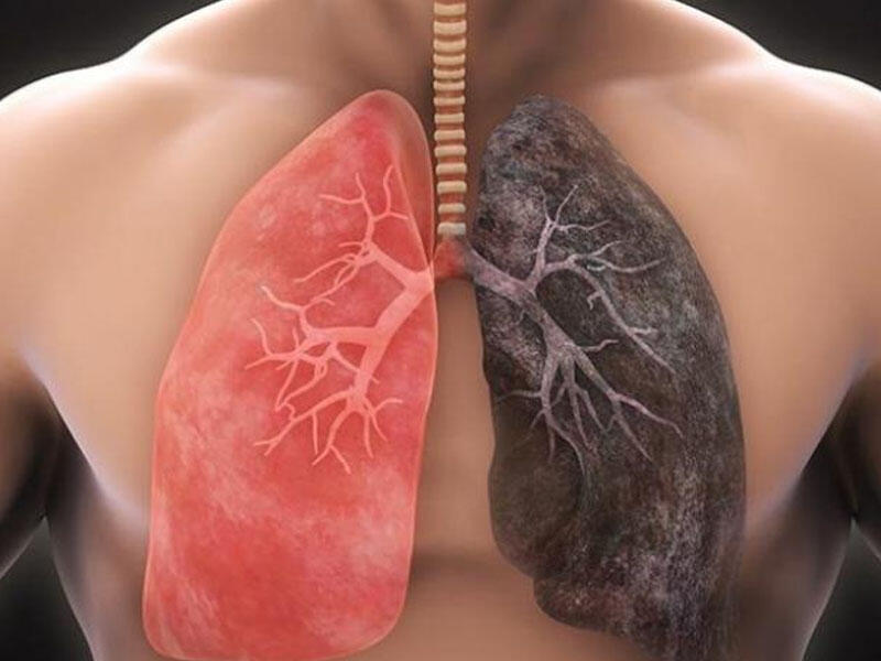 Ağciyərləri toksinlərdən təmizləyən super qidalar- SİYAHI