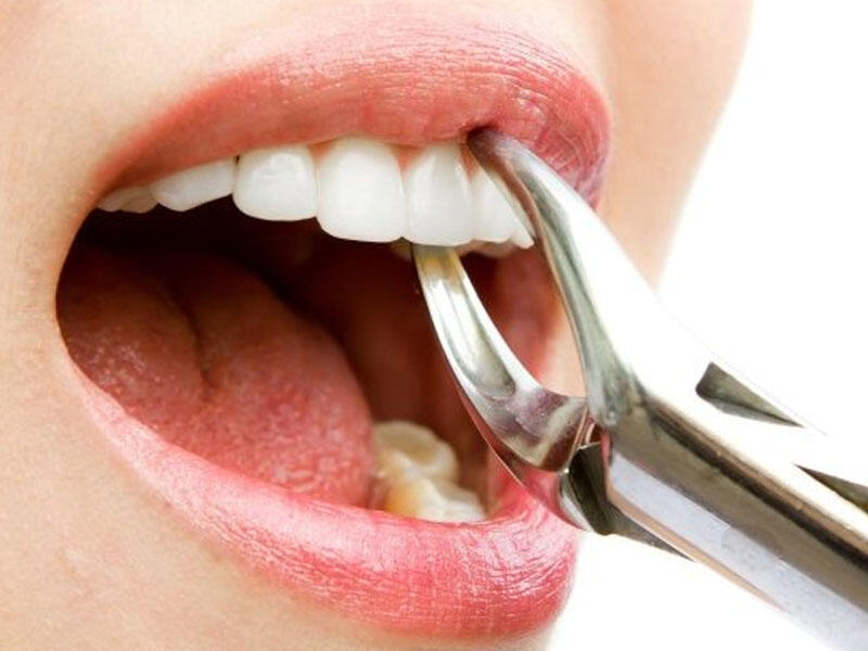 Diş çəkiləndən sonra