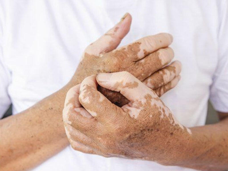 Dermatoloqlar vitiliqonun daha bir səbəbini tapdılar