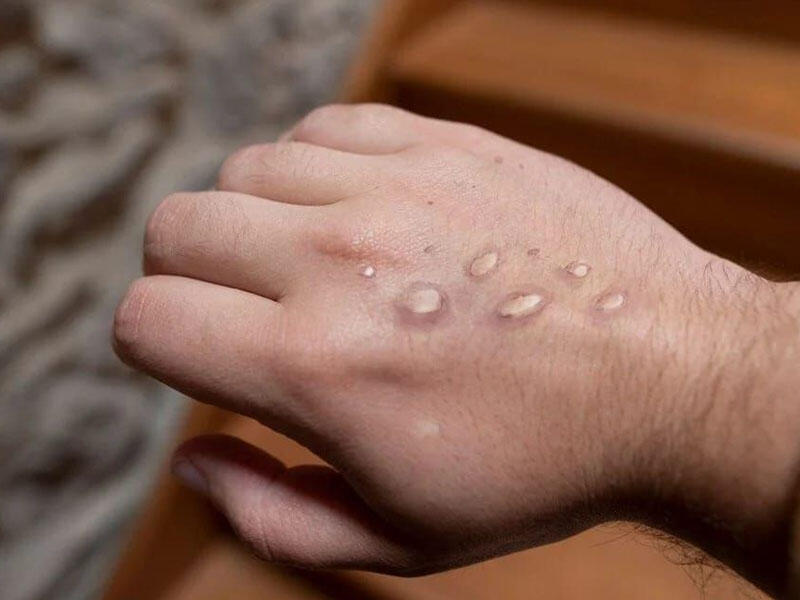 Meymunçiçəyi insandan insana yeni üsulla yoluxur