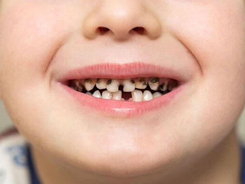 Azərbaycanda uşaqlarda erkən diş çürüməsinin səbəbi açıqlandı