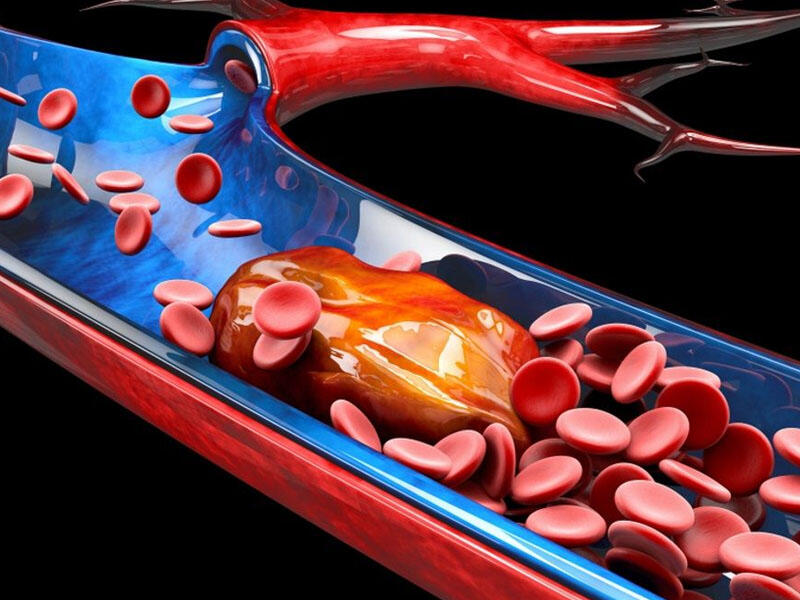 Arteriyaları məhv edən 5 QİDA