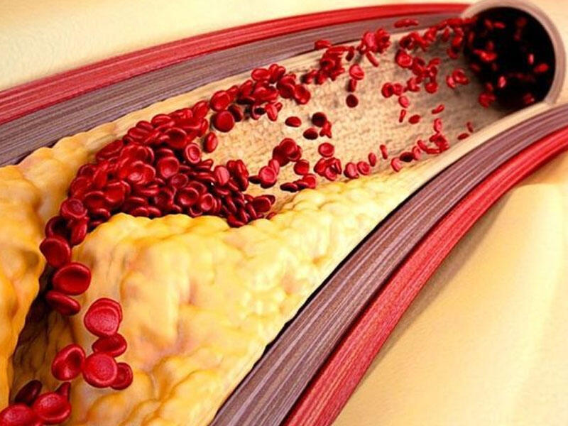 Damarları dərmansız necə təmiz saxlamaq olar? - Kardioloqdan