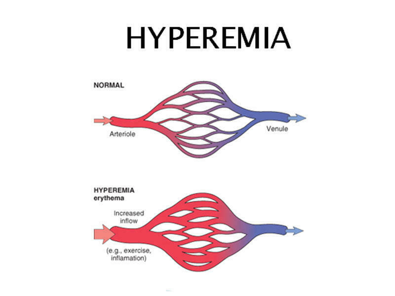 Arterial hiperemiya