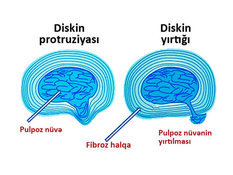 Fəqərəarası diskin protruziyası. Diaqnostika və müalicə