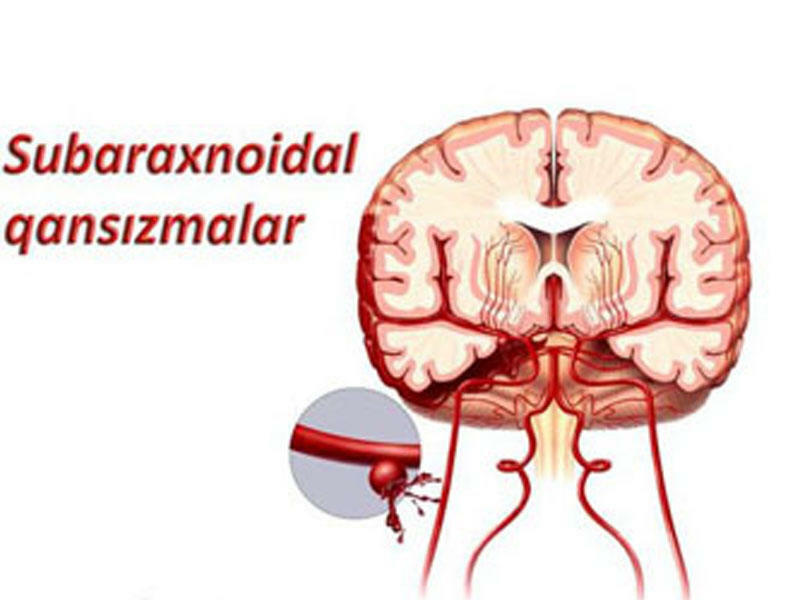 Subaraxnoidal qansızmalar