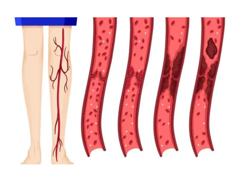 Bu qidalar trombun qarşısını ALIR