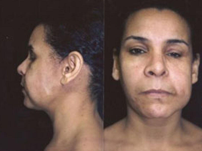 Üzün proqressiv hemiatrofiyası
