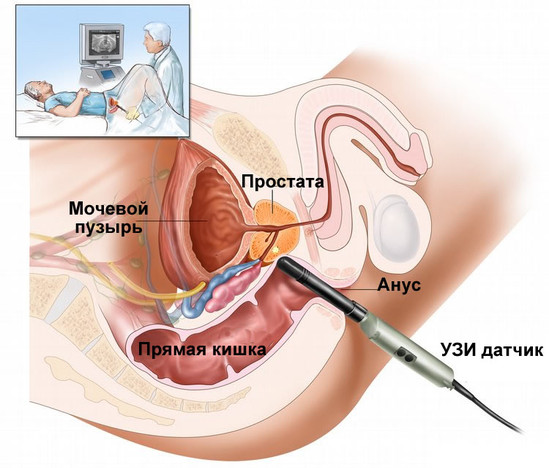 Prostatit