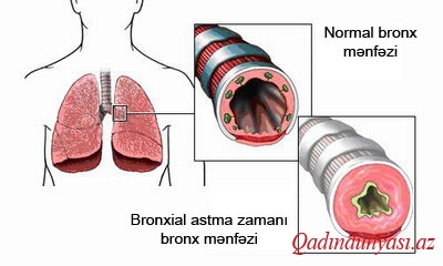 Bronxial Astma
