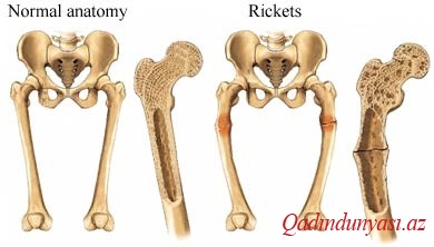 Raxit xəstəliyi haqqında