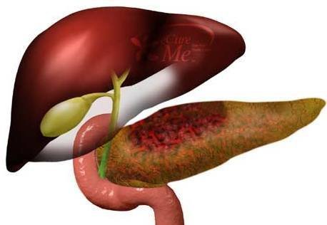 Qaraciyərin və öd (ətiacı) qovuğunun xəstəlikləri – Hepatit xəstəliyinin – təbii müalicəsi