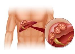 Qaraciyər serrozu, Hepatit C virusunun təbii dərmanı...