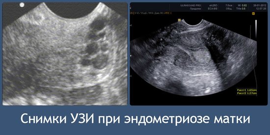 Endometrioz qadınların "baş bəlası" – Sonsuzluğun səbəbidir