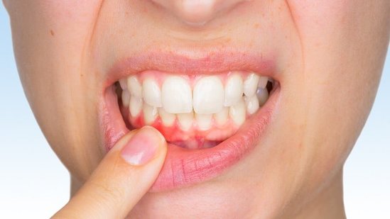 Diş əti xəstəliyini 4 qat artıran səbəb: infeksiya yaradır
