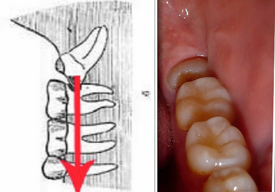Ağıl dişləri haqqında 3 vacib sual-cavab