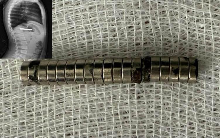 3 yaşlı uşağın boğazından 19 maqnit çıxarıldı - FOTO