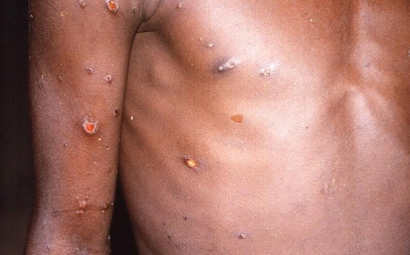 Meymunçiçəyinin hansı səbəbdən artdığı AÇIQLANDI