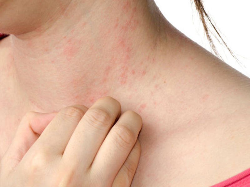 Dərman preparatlarına qarşı allergik xəstəliklər