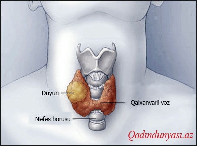 Qalxanvari vəzdəki düyünün müalıcəsi