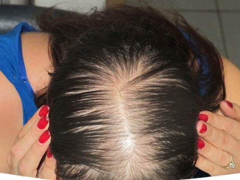 Пучок на макушке. Густые волосы на макушке. Андрогенетическая алопеция. Пробор на макушке. Андрогенная алопеция на макушке.