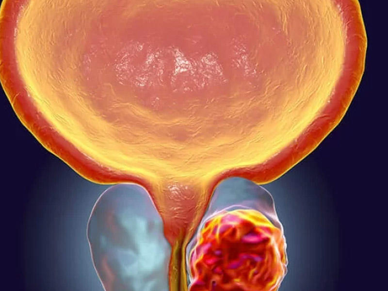 Bəd və xoşxəssəli şişlərin fərqi – Necə müalicə etməli?