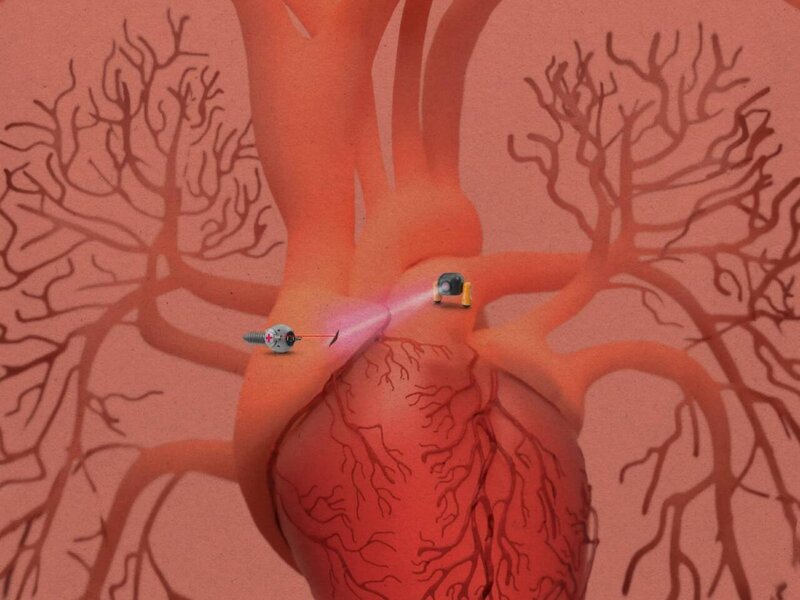 Robot ağrıkəsicilər hazırlandı - Toxumanı tapıb sağaldır, sonra da yox olur