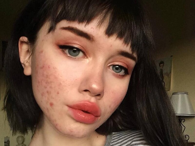 Sızanaqların yaranmasının gözlənilməz səbəbi açıqlandı