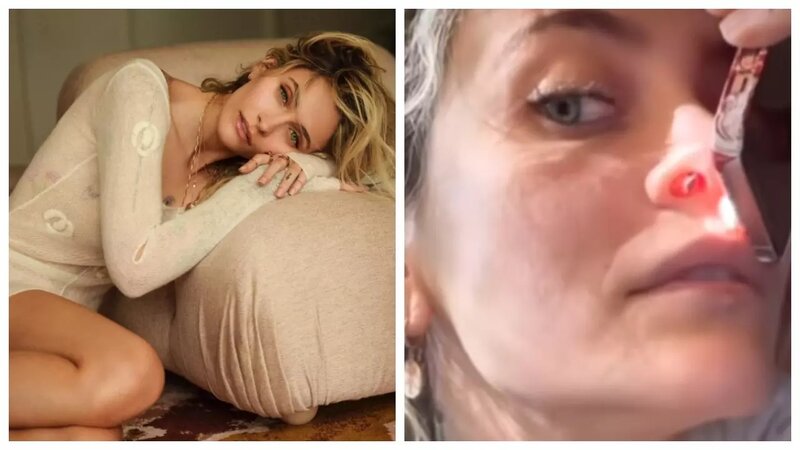 Narkotik Ceksonun qızının burnunda dəlik açdı, əməliyyatdan imtina etdi