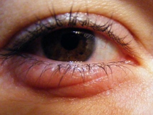 Gözlərin şişməsinə səbəb olan qidalar: menyudan çıxarın