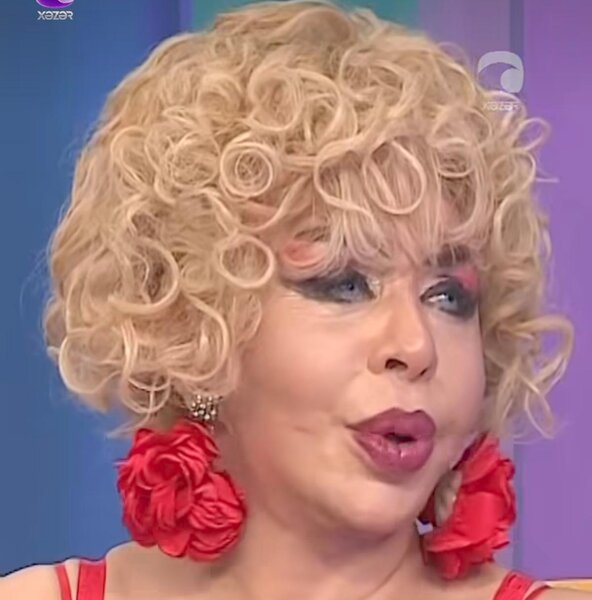 71 yaşlı sənətçi üzgərmə əməliyyatından sonra - FOTO