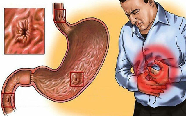 Xroniki qastrit diaqnozu biopsiyasız qoyulmamalıdır - AÇIQLAMA