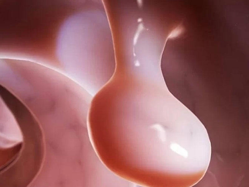 Uşaqlıqda polip - Səbəblər, əlamətlər