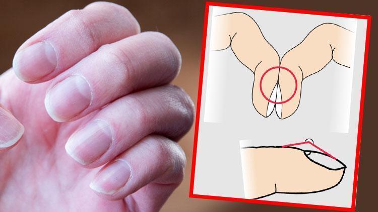 Ölümcül xəstəliyin gizli əlaməti - Barmaqlardakı bu dəyişiklik sizi xəbərdar edir - FOTO