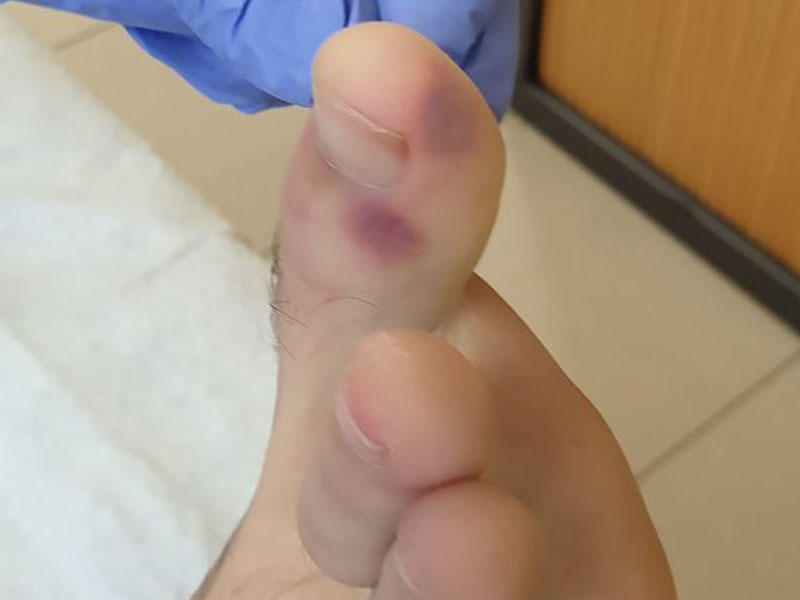 Koronavirusa yoluxub-yoluxmadığınızı bilmək üçün ayaqlarınıza baxın - Yeni əlaməti aşkarlanıb - FOTO