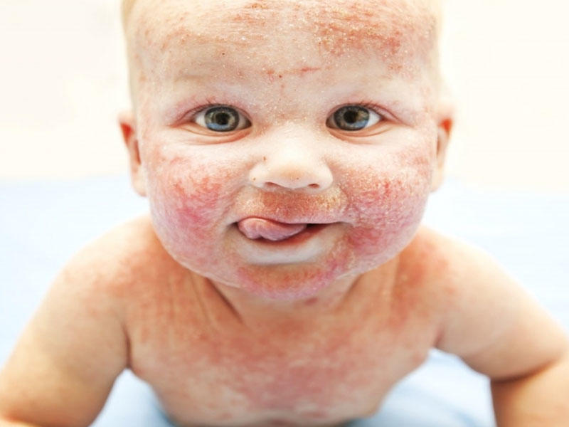 Koronavirus allergiyası olan uşaqlara belə təsir edir - Həkim açıqlaması