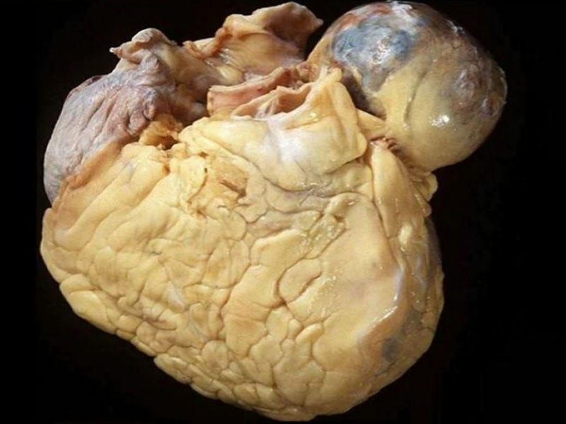 İçki içənlərin ürəyi belə olur - "Pivə ürəyi" sindromu nədir? - FOTO